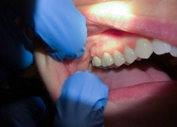 Best Emergency Wisdom Teeth Removal in Springfield, VA